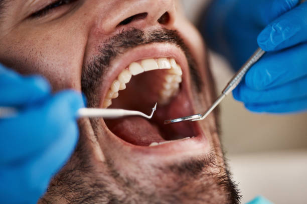 Best Emergency Broken Tooth Repair in Pelican Marsh, FL